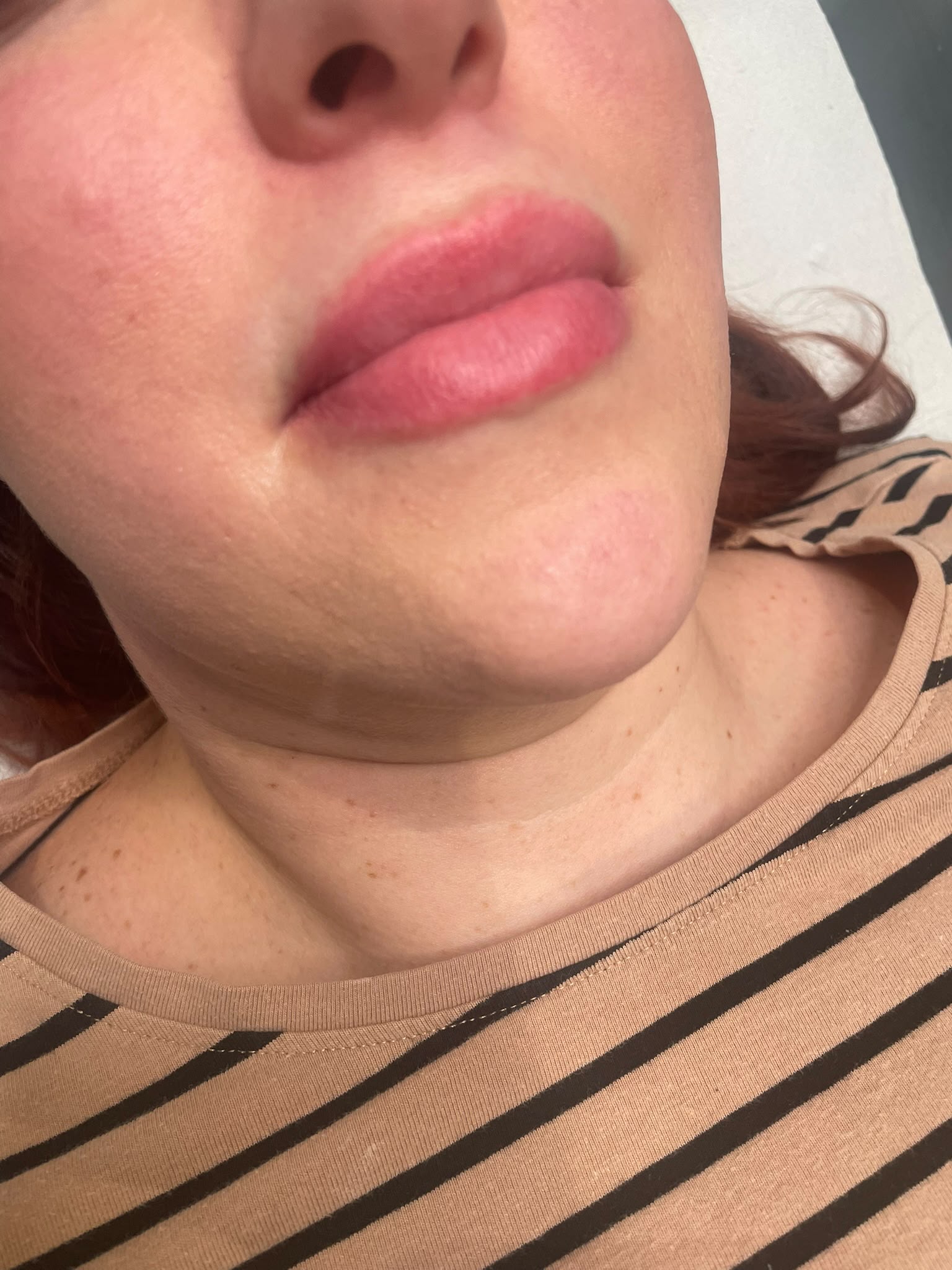 Lip Enhancement — before