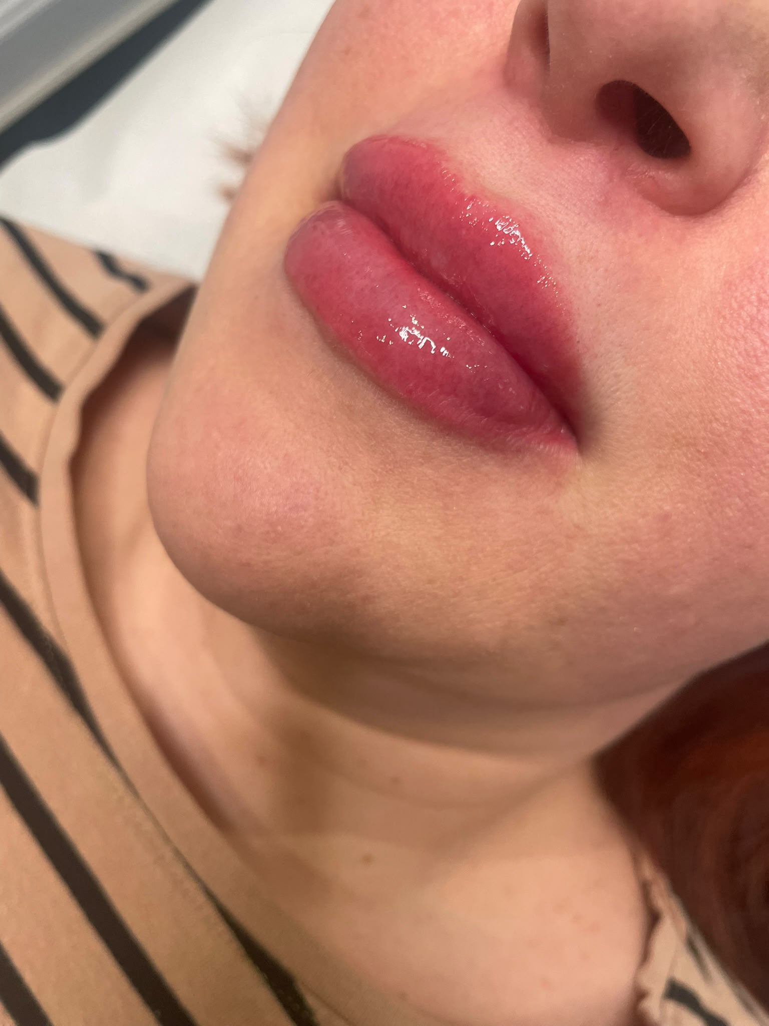 Lip Enhancement — after