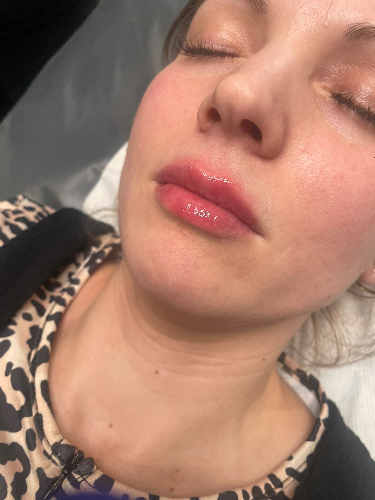 Lip Enhancement — after