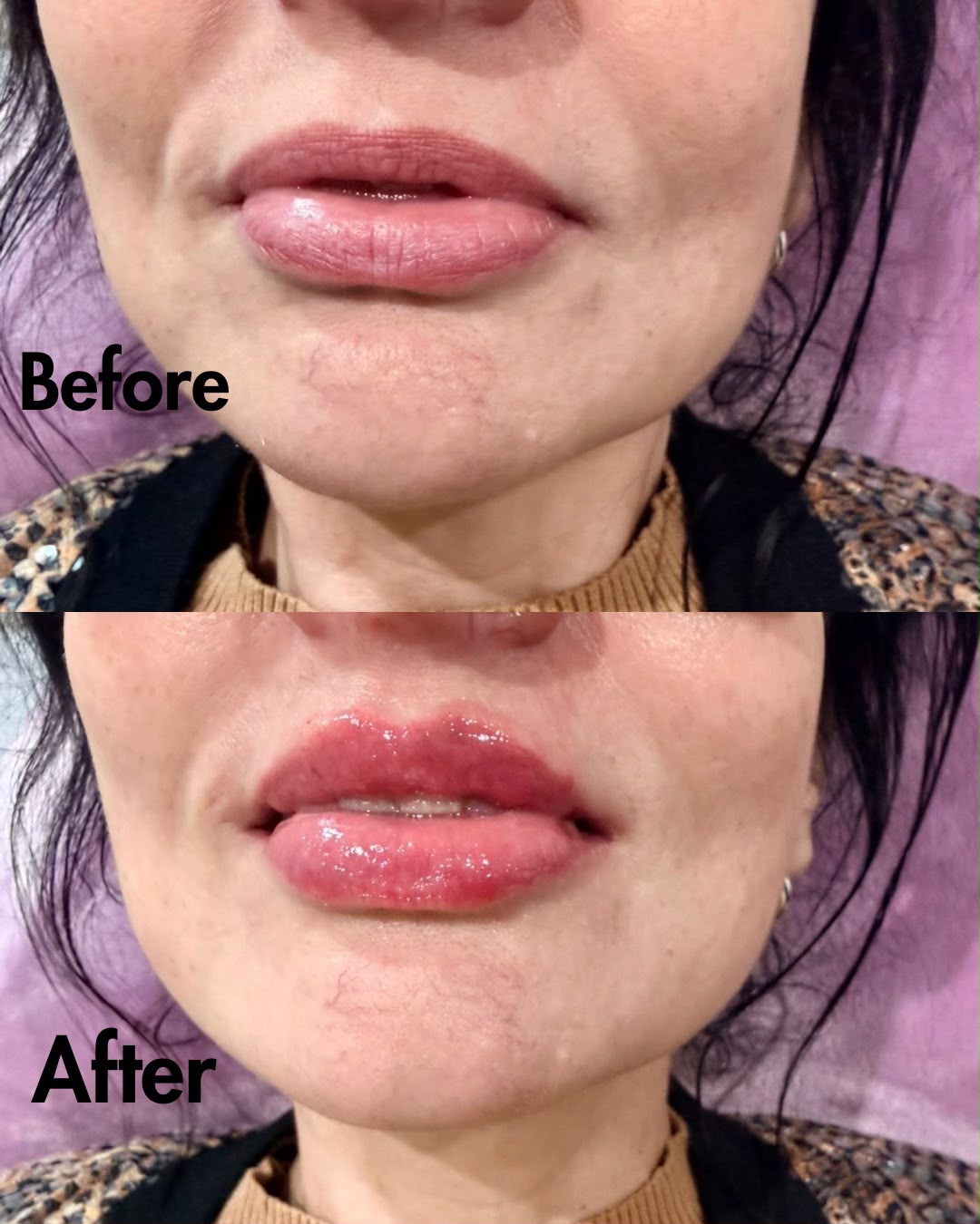 Lip Enhancement — before and after result at A&A Medical Aesthetics