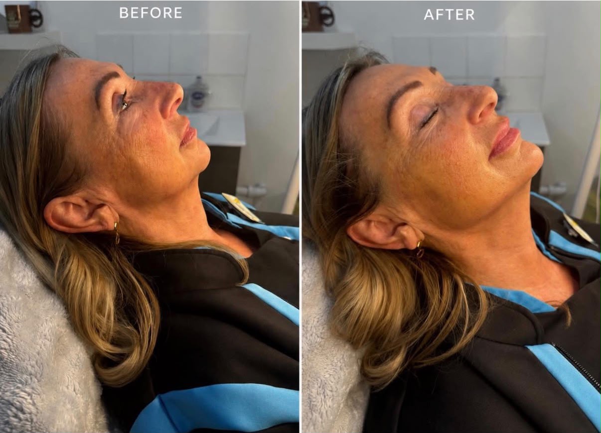 Skin Rejuvenation — before and after result at A&A Medical Aesthetics