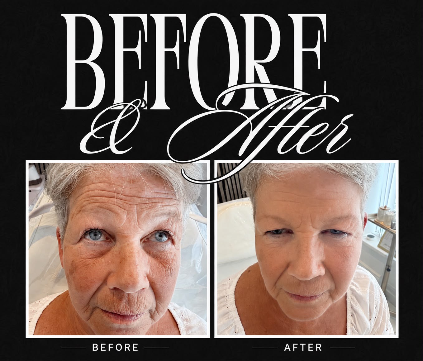 Skin Rejuvenation — before and after result at A&A Medical Aesthetics