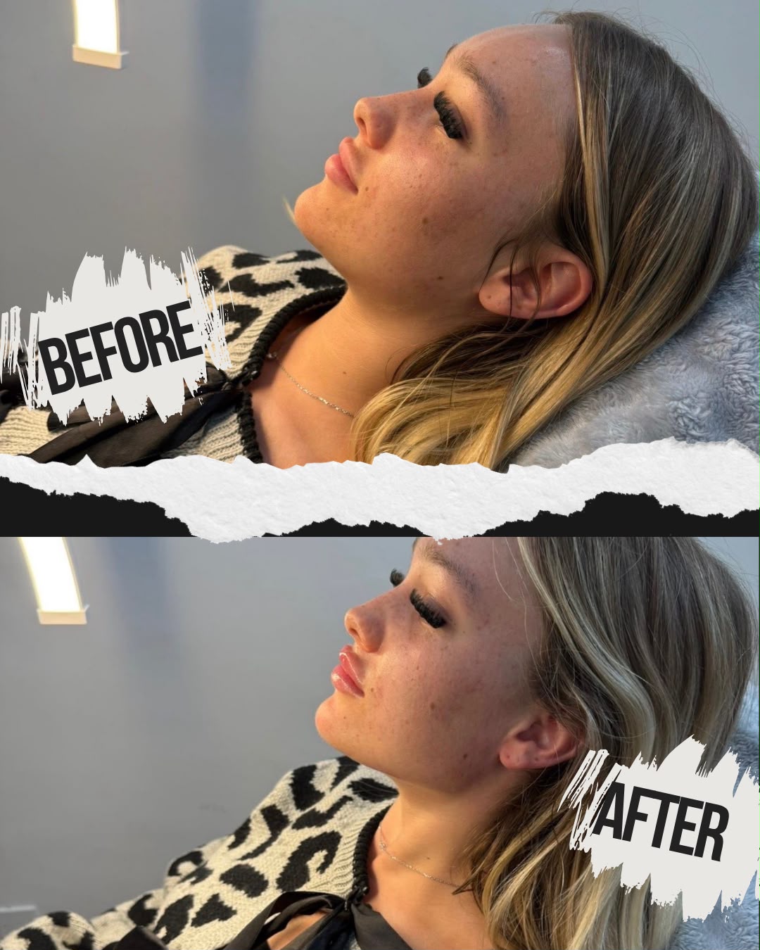 Jawline Definition — before and after result at A&A Medical Aesthetics
